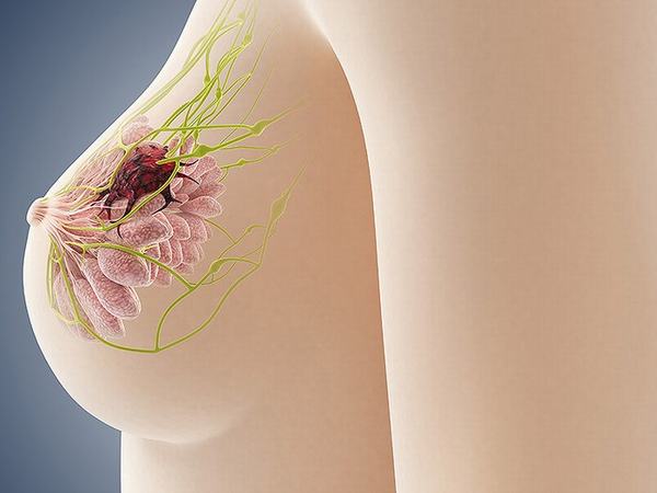 Nổi cục cứng ở vú có thể là lành tính hoặc ung thư vú