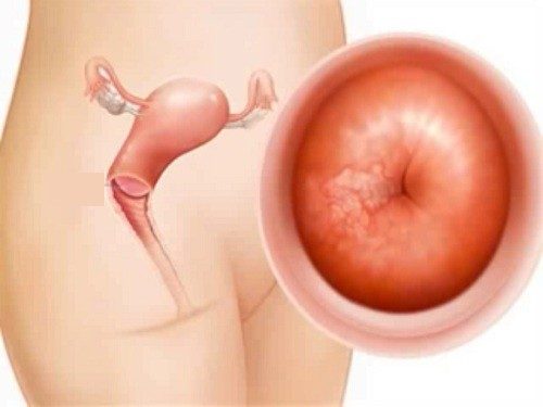 Sau khi cắt bỏ cổ tử cung, chị em không cần làm xét nghiệm Pap hàng năm