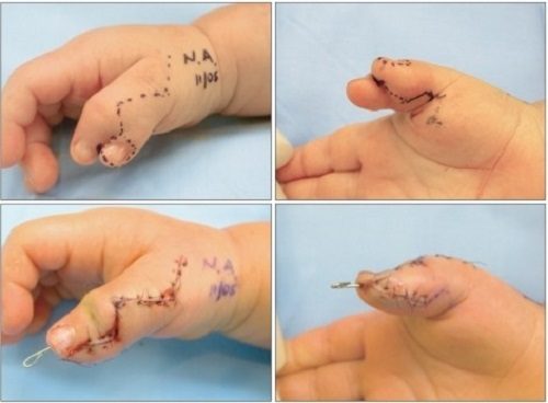 Phẫu thuật được chỉ định trong hầu hết các trường hợp có ngón thừa đặc biệt là ở tay bởi không chỉ ảnh hưởng đến thẩm mỹ mà chúng còn khiến chức năng của bàn tay