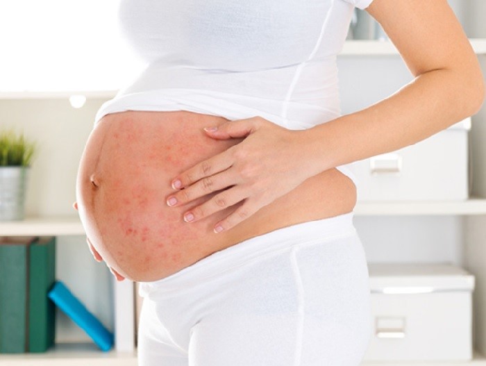 Phụ nữ mang thai bị thủy đậu sẽ ảnh hưởng nghiêm trọng đến sức khỏe của thai kỳ, nhất là những mẹ bầu chưa từng bị nhiễm bệnh, hoặc là chưa từng tiêm vắc xin phòng ngừa thủy đậu