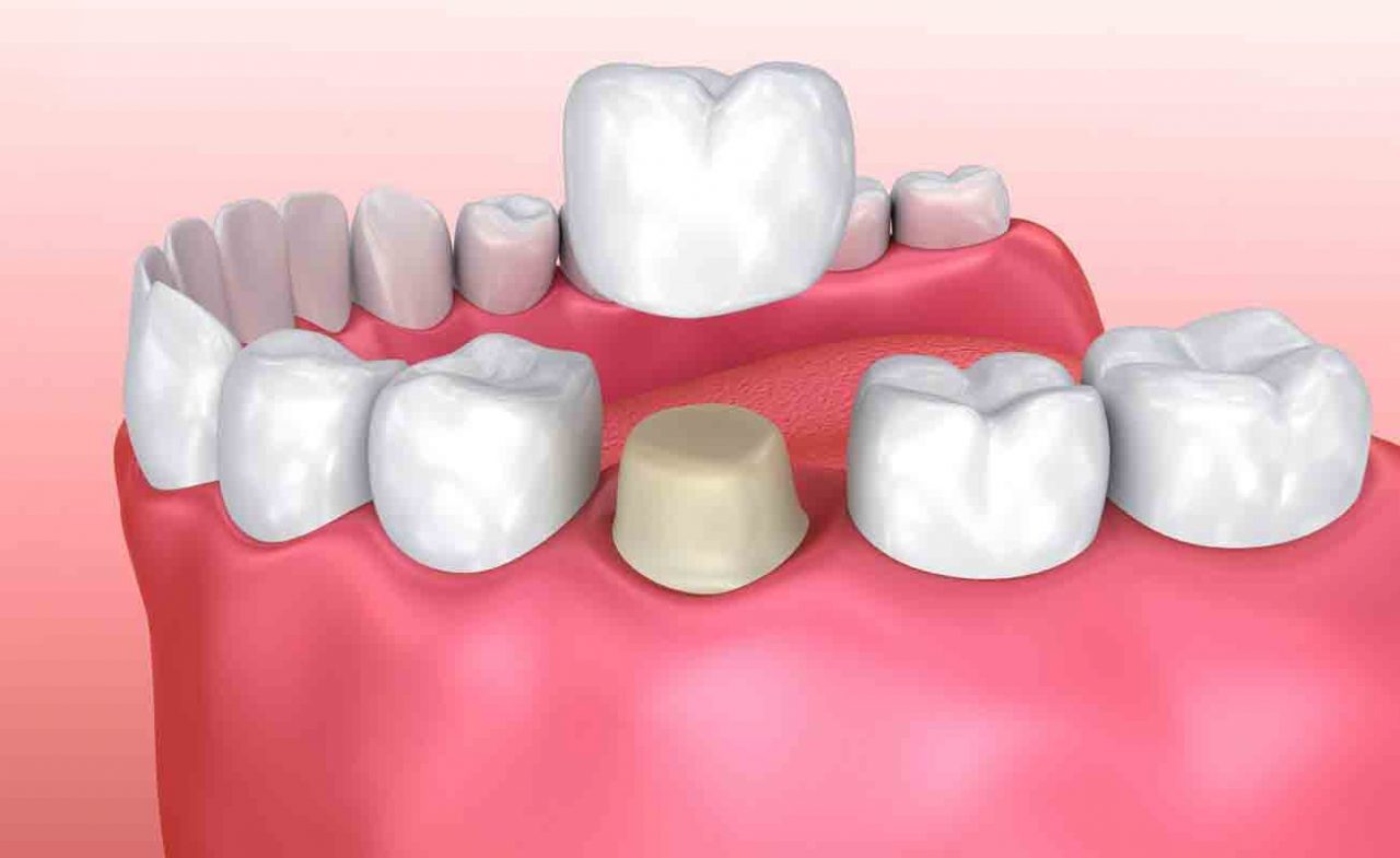 Răng sứ có thể tương thích với cấu trúc răng hàm tự nhiên không?
