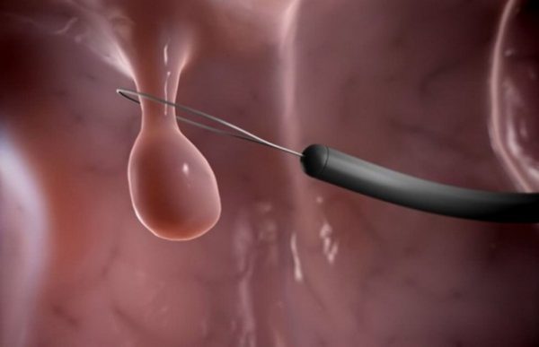 Xuất huyết do Polyp cổ tử cung có thể điều trị bằng phương pháp nội khoa và ngoại khoa