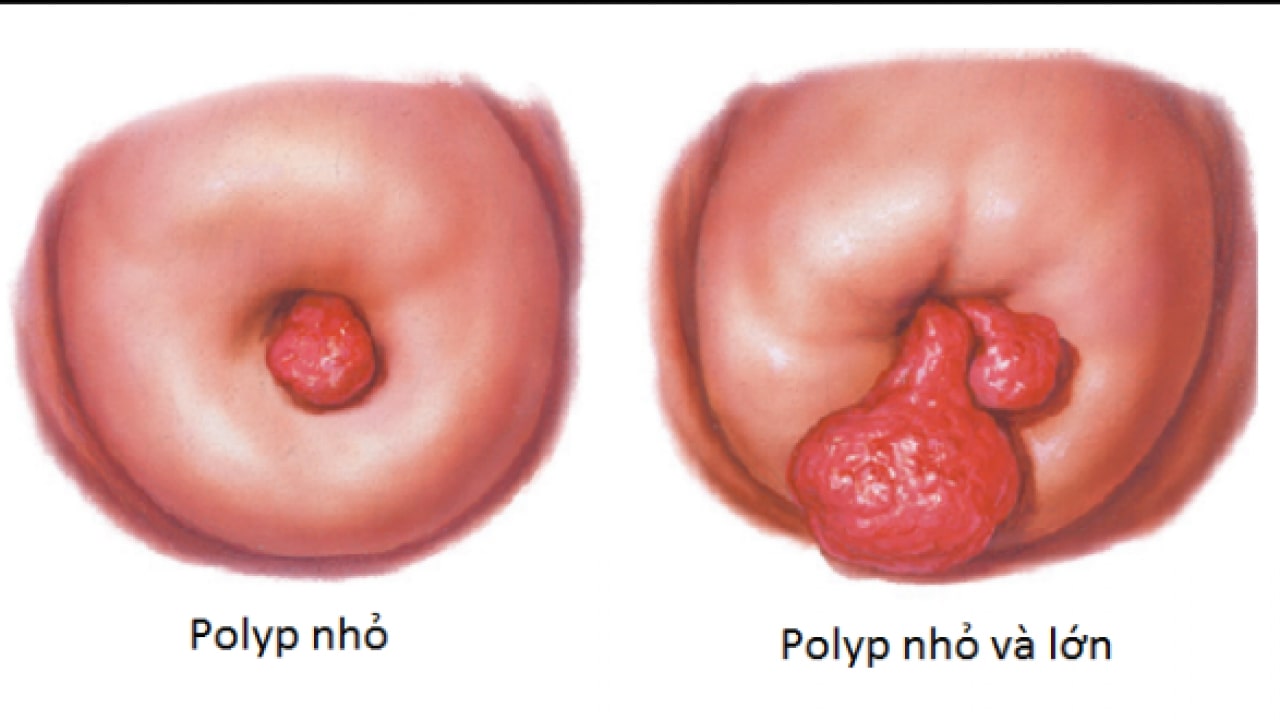 Polyp cổ tử cung gây chảy máu điều trị thế nào? | TCI Hospital