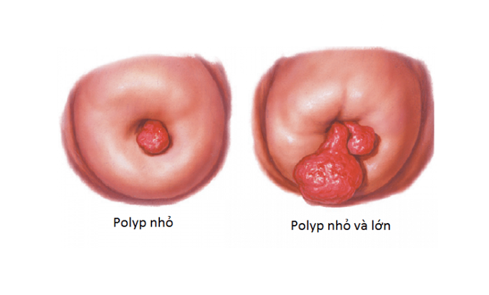 hình ảnh polyp cổ tử cung là một bệnh lý phụ khoa khá nhiều chị em mắc phải