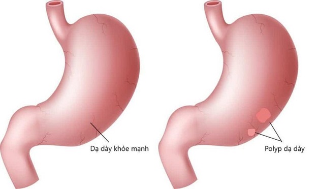 Vì sao người dễ mắc bệnh polyp dạ dày?
