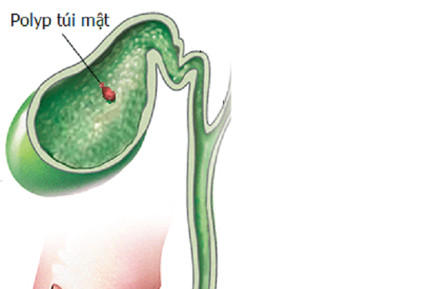 Polyp túi mật 3mm là gì? Điều trị thế nào?