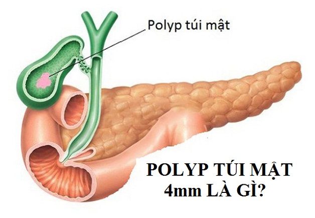 polyp-t-i-m-t-4mm-l-g-c-c-n-ph-u-thu-t-kh-ng-welcome-eumerci