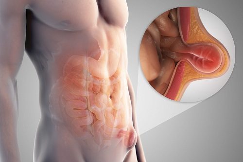 Thoát vị bẹn là bệnh lý thường gặp ở nam giới, xảy ra khi các tạng trong ổ bụng như mạc nối, ruột bị chui qua ống bẹn – nơi có ống dẫn tinh chạy qua.