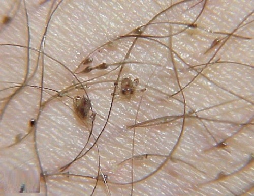 Tại sao nhiều người phát hiện rận mu ở khu vực lông mu sau khi tẩy lông vùng kín?
