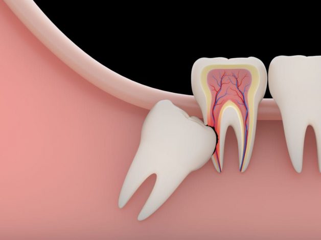 Nhổ 4 răng khôn cùng lúc được không? | TCI Hospital
