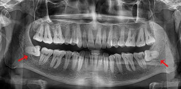 Vị trí răng số 8 ở đâu? Khi nào nên nhổ răng số 8? | TCI Hospital
