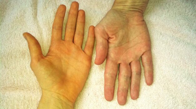 Vàng da là triệu chứng điển hình của các bệnh lý về gan