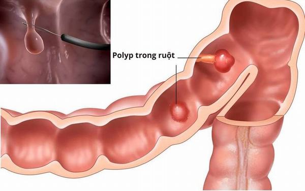 Sau cắt polyp đại tràng người bệnh nên chú ý ăn uống, sinh hoạt
