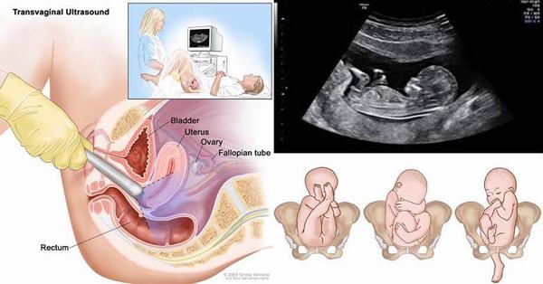Siêu âm đầu dò thường được chỉ định trong theo dõi thai kỳ ở giai đoạn sớm
