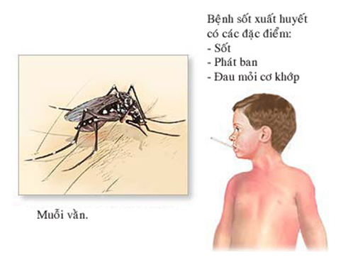 Sốt xuất huyết là bệnh truyền nhiễm cấp tính do siêu vi trùng Dengue  gây ra.