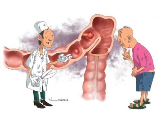 Tắc ruột là tình trạng thức ăn bị tắc nghẽn, ứ đọng lại trong ruột, không thể đi xuống dưới để tiếp tục quá trình tiêu hóa