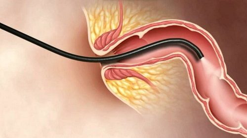 Nội soi đại tràng là một thủ thuật thăm khám toàn bộ bên trong đại tràng bằng một ống nội soi mềm, được luồn vào cơ thể qua lỗ hậu môn