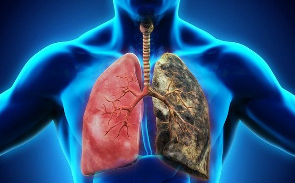 Tầm soát ung thư phổi: Phát hiện sớm bệnh - Điều trị dễ dàng