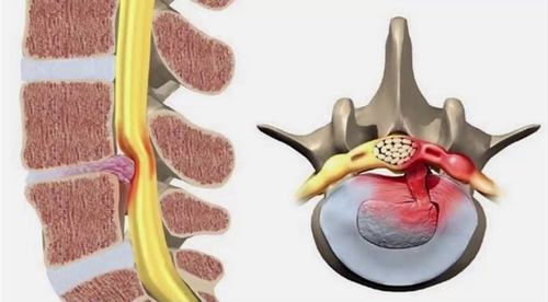 Thoát vị đĩa đệm cột sống lưng và những điều cần biết | TCI Hospital