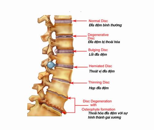 Thoát Vị Đĩa Đệm Đa Tầng Là Gì? Tìm Hiểu Nguyên Nhân, Triệu Chứng và Phương Pháp Điều Trị