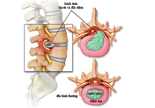 Nguyên nhân gây tê chân ở bệnh nhân thoát vị đĩa đệm là gì?
