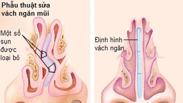 Mổ Nội Soi Vách Ngăn Mũi: Quy Trình, Lợi Ích Và Những Điều Cần Biết