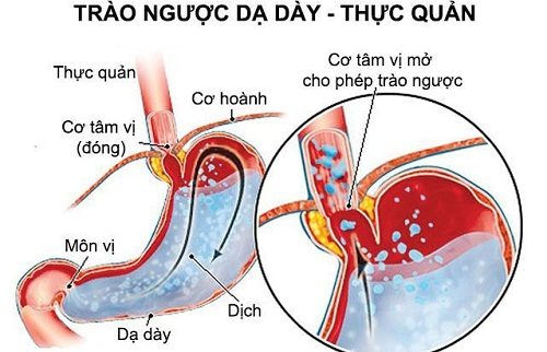 Trào ngược dạ dày thực quản - bệnh của dân văn phòng