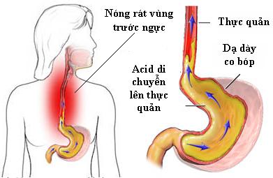 Thuốc chữa trào ngược dạ dày thực quản | TCI Hospital