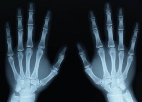 Dấu hiệu nhận biết trật khớp ngón tay chính là đau mạnh kèm theo sự biến dạng của ngón tay như cong vênh