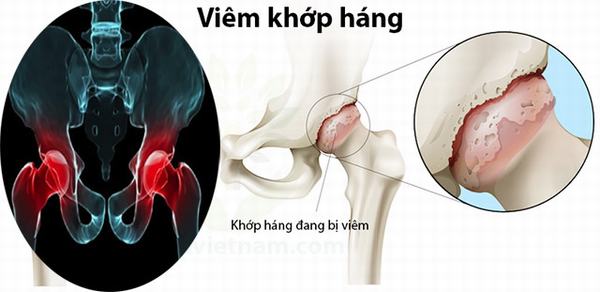 Viêm khớp háng gây ra cảm giác đau đớn, khó chịu, khó khăn khi đi lại, vận động