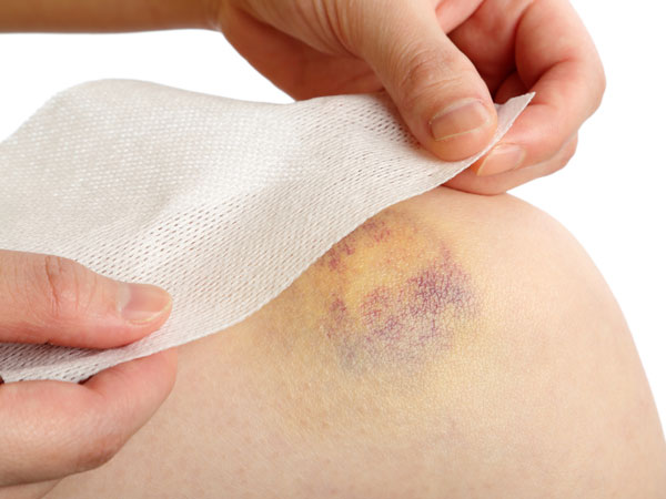 Vết bầm trên da cũng có thể là dấu hiệu cảnh báo ung thư máu