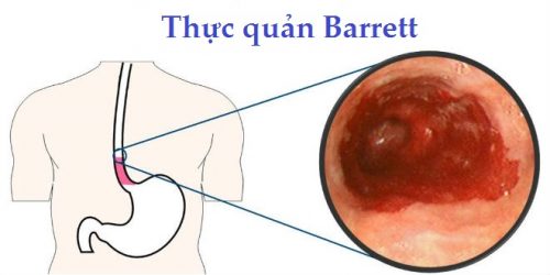 Barrett thực quản là một trong những bệnh đường tiêu hóa phổ biến, thường gặp ở những người mắc bệnh trào ngược dạ dày thực quản kéo dài.