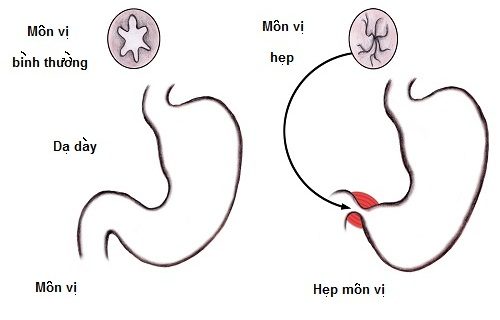 Nguyên nhân gây ra hội chứng hẹp môn vị là gì?
