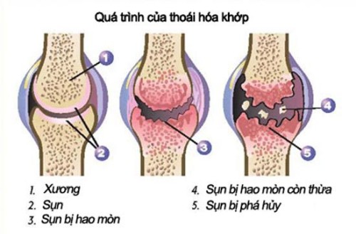 Những nguy cơ gây ra bệnh cơ xương khớp là gì?
