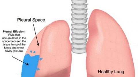 Dấu hiệu tràn dịch màng phổi bạn nên biết