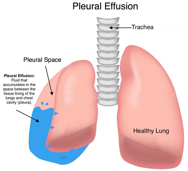 Tràn dịch màng phổi là tình trạng có nhiều dịch hơn bình thường trong khoang màng phổi 