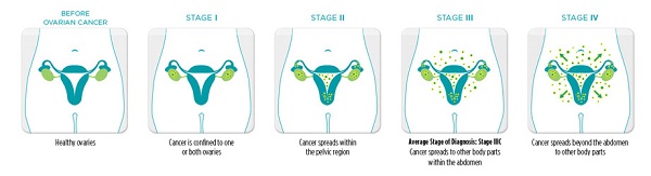 Ung thư buồng trứng giai đoạn III