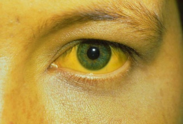 Vàng da, vàng mắt phổ biến ở bệnh nhân ung thư gan