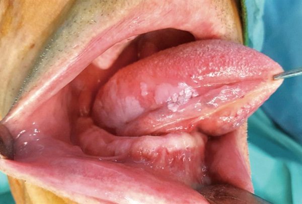 Các biểu hiện ung thư lưỡi giai đoạn đầu dễ bị bỏ qua