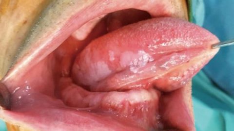Triệu chứng ung thư lưỡi giai đoạn đầu