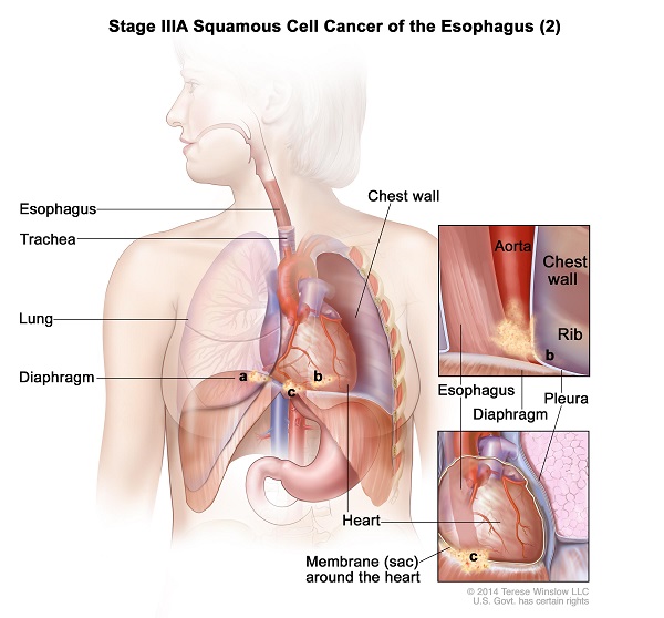 Ung thư thực quản giai đoạn III