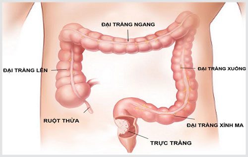 Viêm trực tràng là bệnh lý thường gặp ở đường tiêu hóa