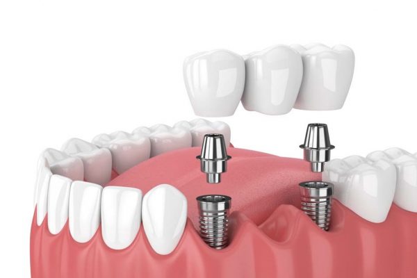Cấu tạo răng implant gồm 3 phần