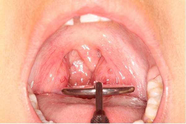U cứng trên vòm họng là bị làm sao là thắc mắc được nhiều người đặt ra khi xuất hiện triệu chứng này