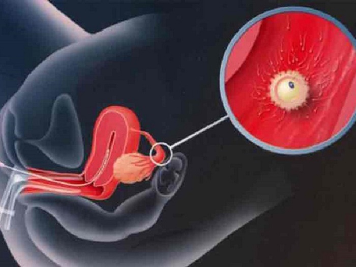 U nang bì buồng trứng khi mang thai