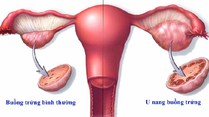 U nang buồng trứng là căn bệnh phổ biến ở chị em phụ nữ, nhất là những người đang ở trong độ tuổi sinh đẻ