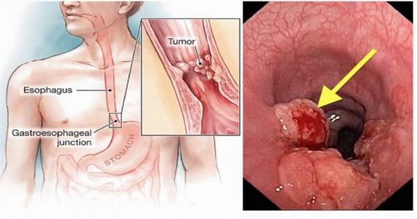 U thực quản lành tính và những điều cần biết | TCI Hospital