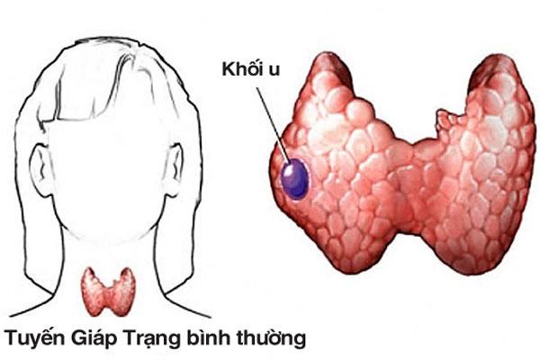 U tuyến giáp lành tính kiêng ăn gì - giải đáp ngay