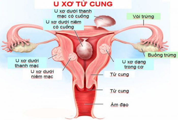 Bệnh u xơ tử cung được nhắc đến là bệnh phụ khoa phổ biến ở nữ giới đang trong độ tuổi sinh sản