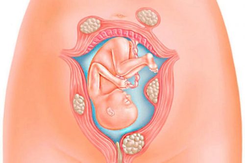 U xơ tử cung gây nguy hiểm cho thai nhi trong quá trình mang thai